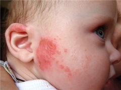 Характерный признак аллергии у детей сыпь
